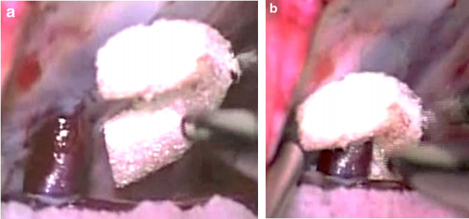 【图3a和b，a图表示术中小脑表面穿过天幕的大口径桥静脉，b图表示一块U形的凝胶泡沫用于加强天幕入口处的静脉壁（b）。随后，这个区域被纤维蛋白胶覆盖】