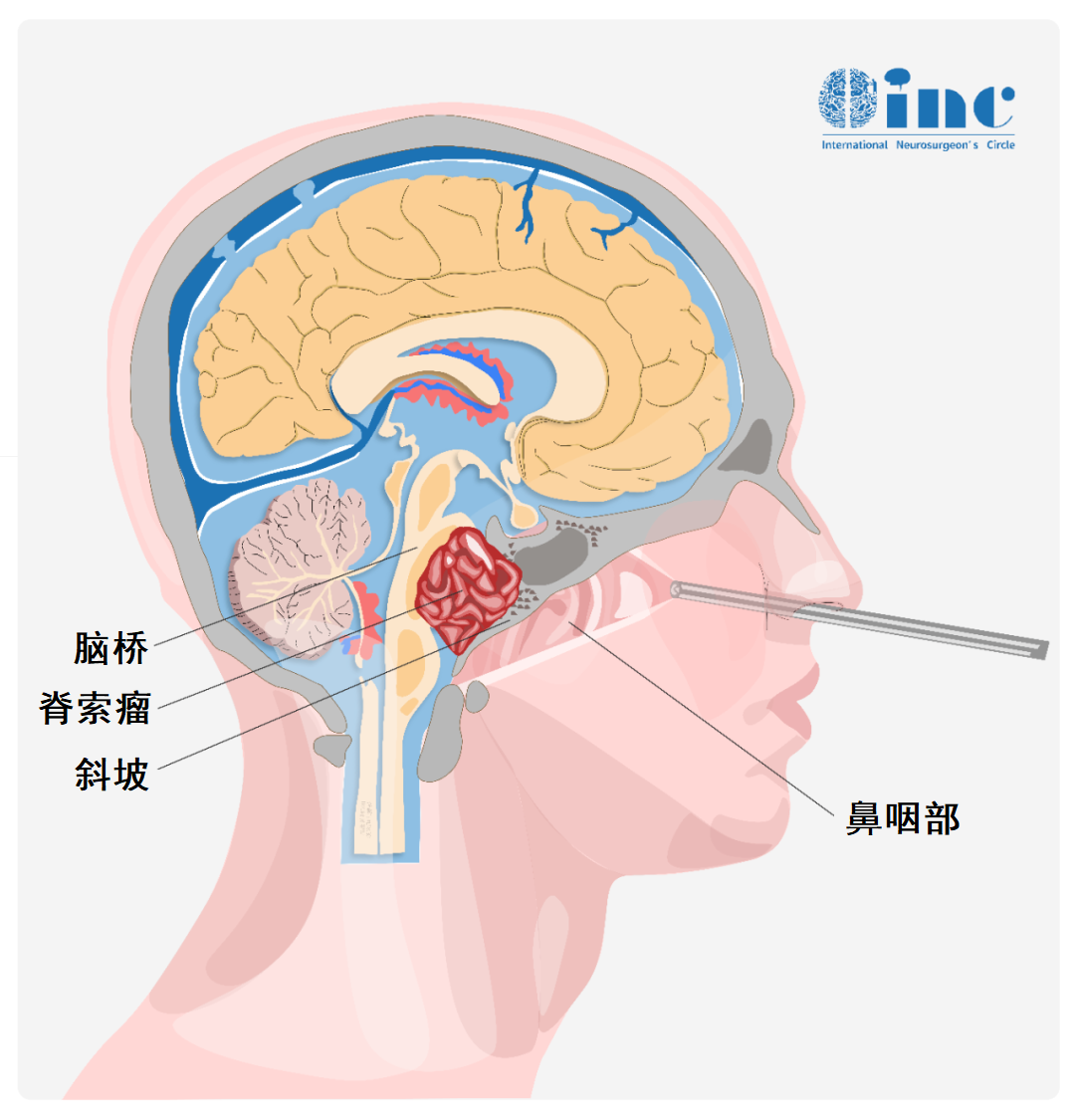 图示为内镜经鼻入路切除脊索瘤