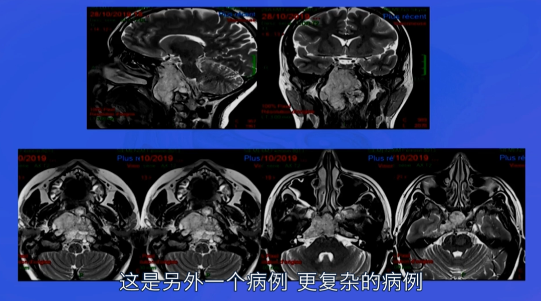 从鼻子切脑子里的肿瘤