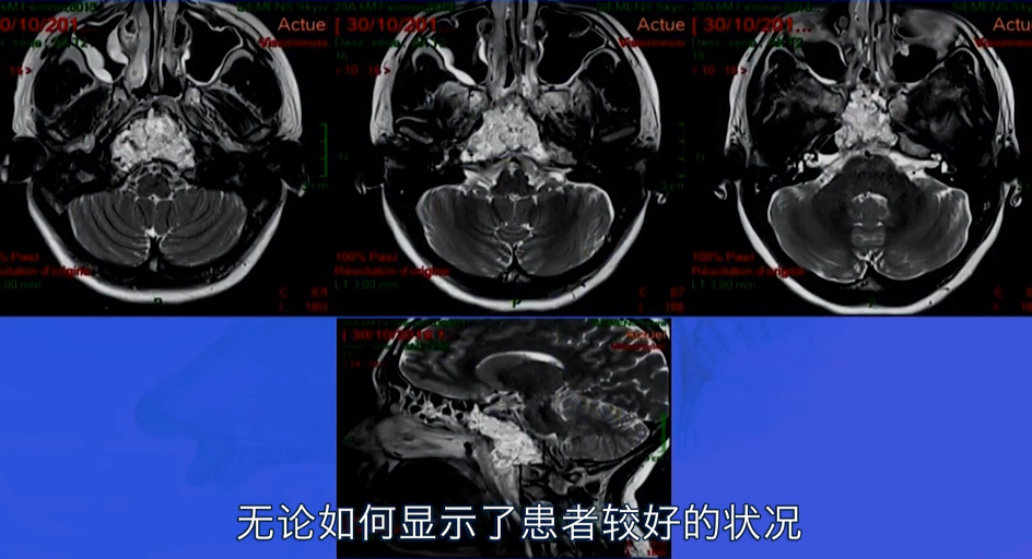 术后MRI