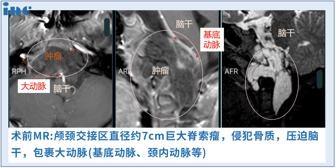 儿童鼻内镜手术比成人更难