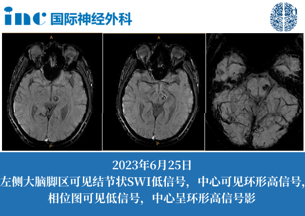 18岁男孩-脑干海绵状血管瘤