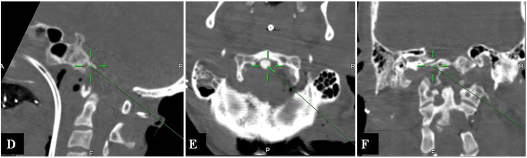 D-F：术中在CT引导神经导航下，进行EA-FLTA入路手术，显示进入斜坡(D)、齿状突(E)和对侧OC(F)的手术操作可行性。