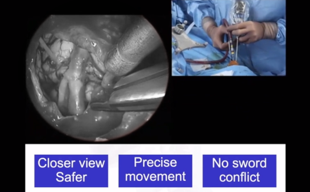 福洛里希教授神经内镜“筷子手术”演示