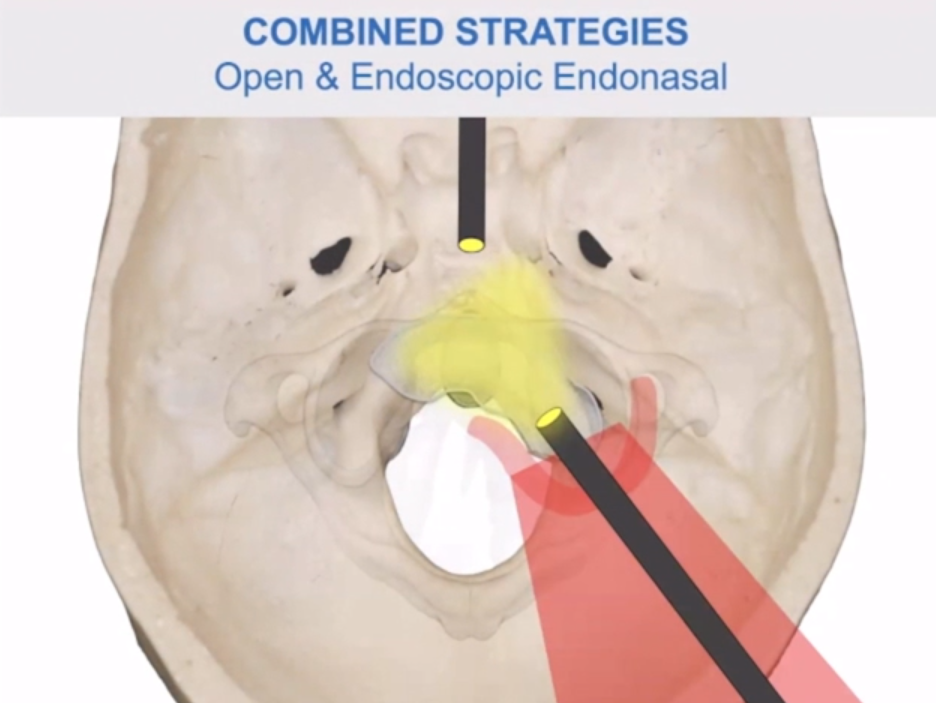 内镜辅助下远外侧经髁入路治疗颅颈交界区脊索瘤的优势