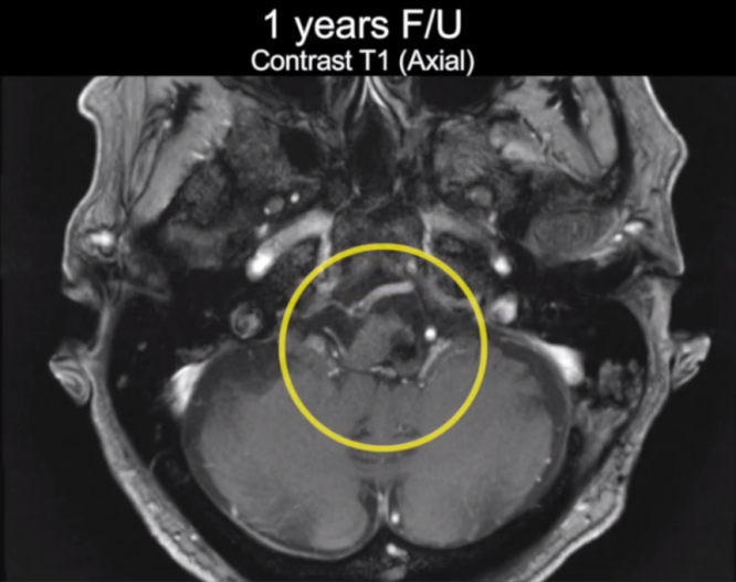术后一年复查MR，未见复发，脑组织正常