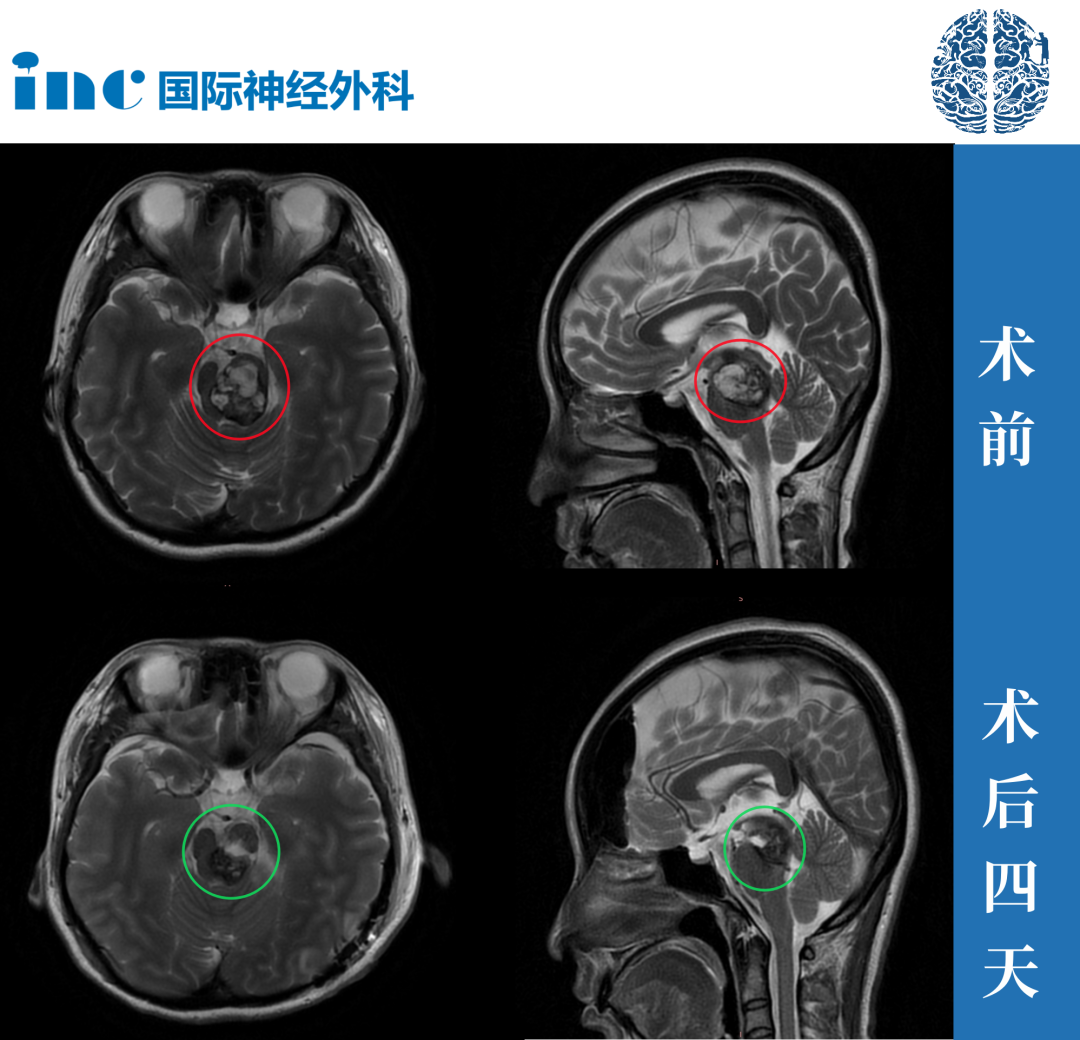 脑干海绵状血管瘤案例