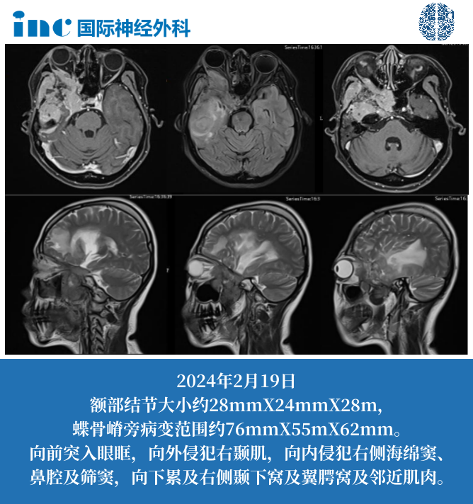 42岁女性-右侧颞部、蝶骨嵴旁脑膜瘤复发