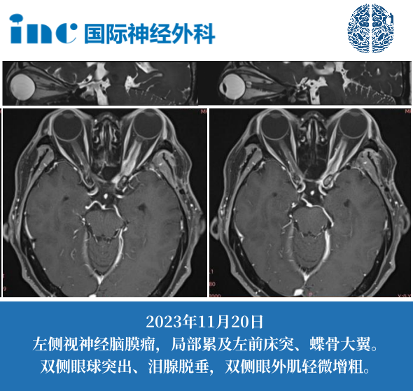 57岁女性-左侧视神经脑膜瘤（术