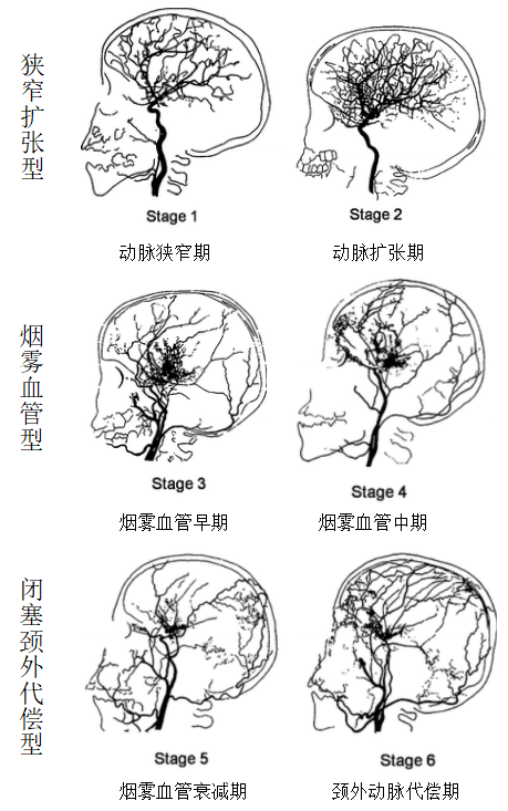 “烟雾病”危重患者的诊断疑云