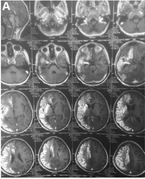 图1术前脑MRI（A）显示右侧大脑中动脉和右侧大脑前动脉区域急性缺血。