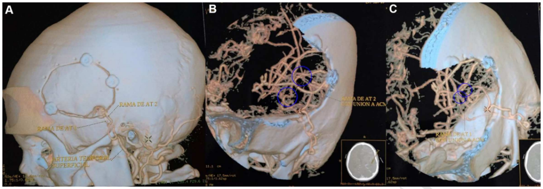 图2术后CTA的3D重建显示开颅手术大小，以及在左侧颞浅动脉和左侧大脑中动脉之间进行的两次搭桥血管重建。