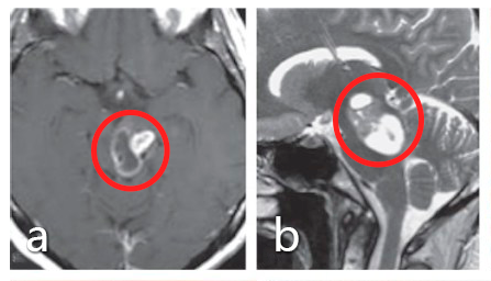 术前：a、b图患者术前MRI显示中<a href='/naoliu/' target='_blank'><u>脑肿瘤</u></a>，患者最初接受立体定向囊肿抽吸和间质放疗，并被诊断为毛细胞型星形细胞瘤，但肿瘤仍在生长。