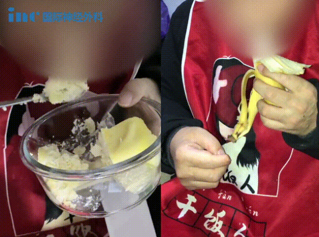 福洛里希教授较大脊索瘤案例