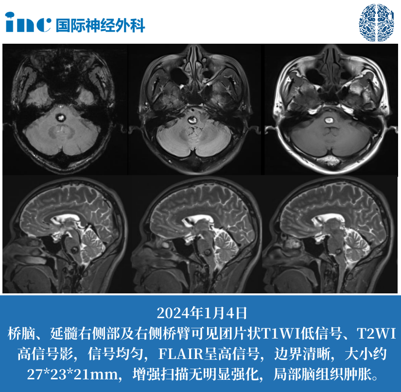 52岁男性-脑干（桥脑）海绵状血管瘤并出血
