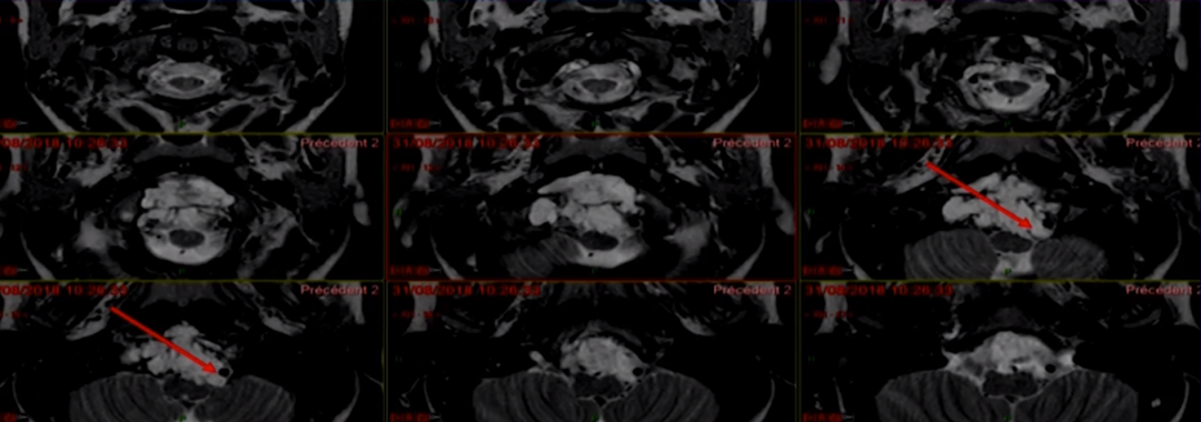 术前MRI