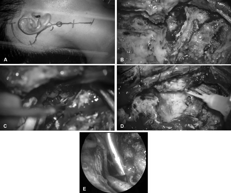 图2，外科手术的步骤。(A)沿胸锁乳突肌前缘切口，穿过乳突上方。(B)切除钻取枕髁和乳突尖端后的肿瘤包膜视图。(C)从对侧颈静脉孔的神经进行硬膜内肿瘤剥离。(D)使用游离脂肪移植物闭合硬膜缺损。(E)内镜硬膜内探查显示对侧颈静脉孔有肿瘤残留，需要继续进行肿瘤切除。