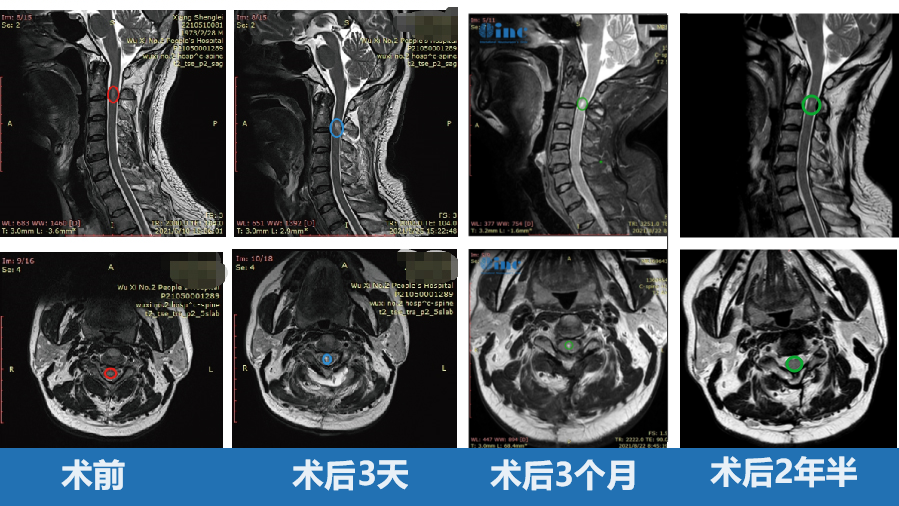 脊髓髓内肿瘤真实成功案例——术前