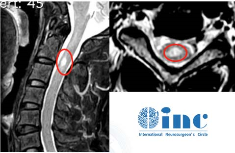 脊髓髓内肿瘤真实成功案例——术前