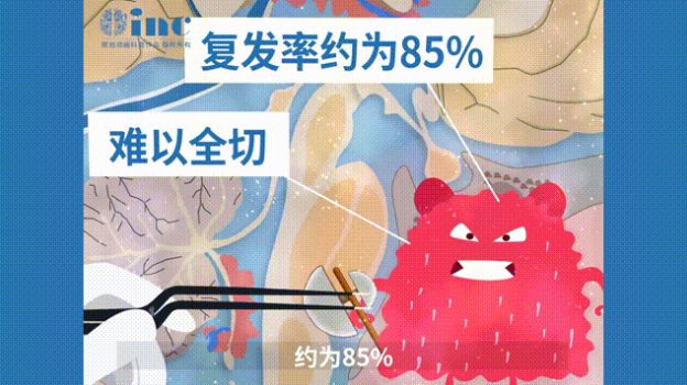全切较大脊索瘤