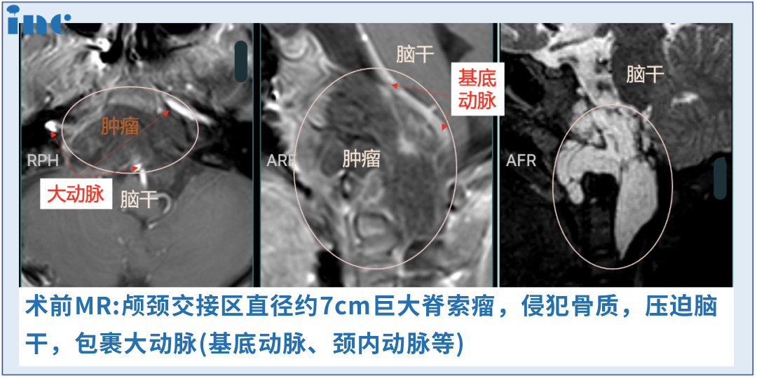 6岁男孩-巨大脊索瘤压迫脑干  　　4年内3次手术，多次复发，从未放弃生存希望