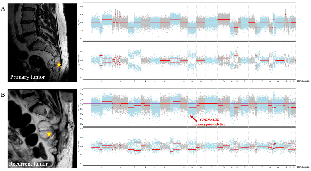 骶骨原发性(A)与其局部复发(B)脊索瘤CNV特征之间的比较。我们在复发脊索瘤中观察到CDKN2A/2B的纯合缺失（红色箭头）。黄色星星表示脊索瘤。