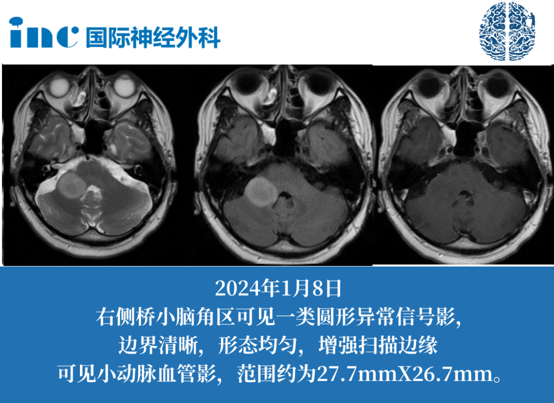 39岁男性-桥臂胶质瘤  　　身体无症状，却意外查出胶质瘤！手术or被动观察？