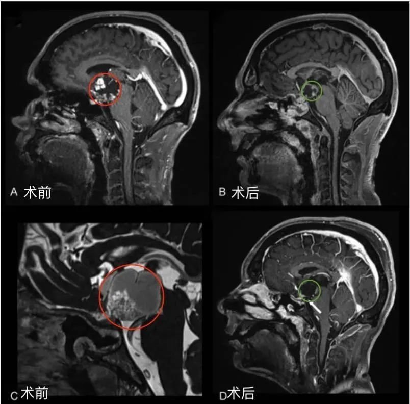 35岁男性后视交叉性较大颅咽管瘤