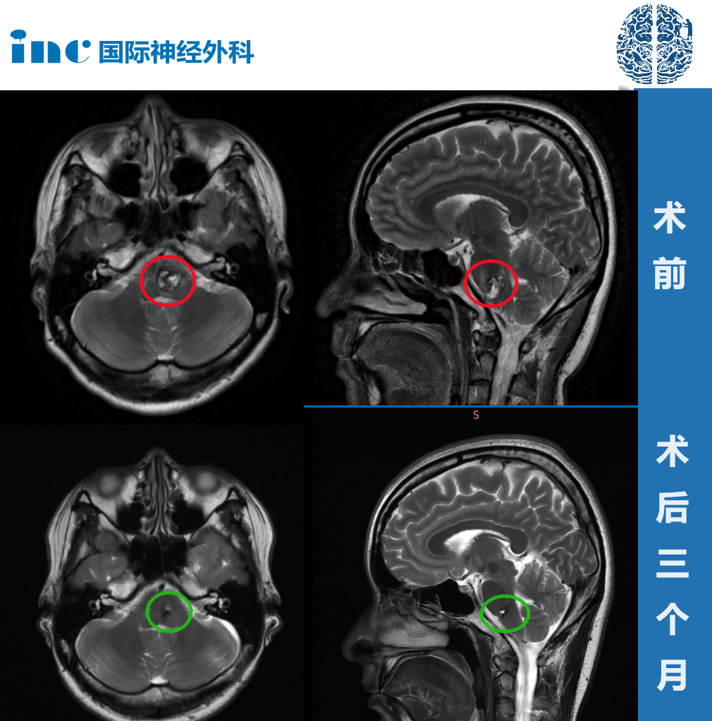 28岁高难度脑干延髓海绵状血管瘤真实案例