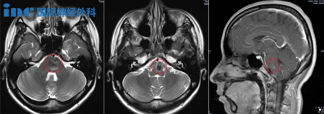 28岁高难度脑干延髓海绵状血管瘤真实案例影像资料