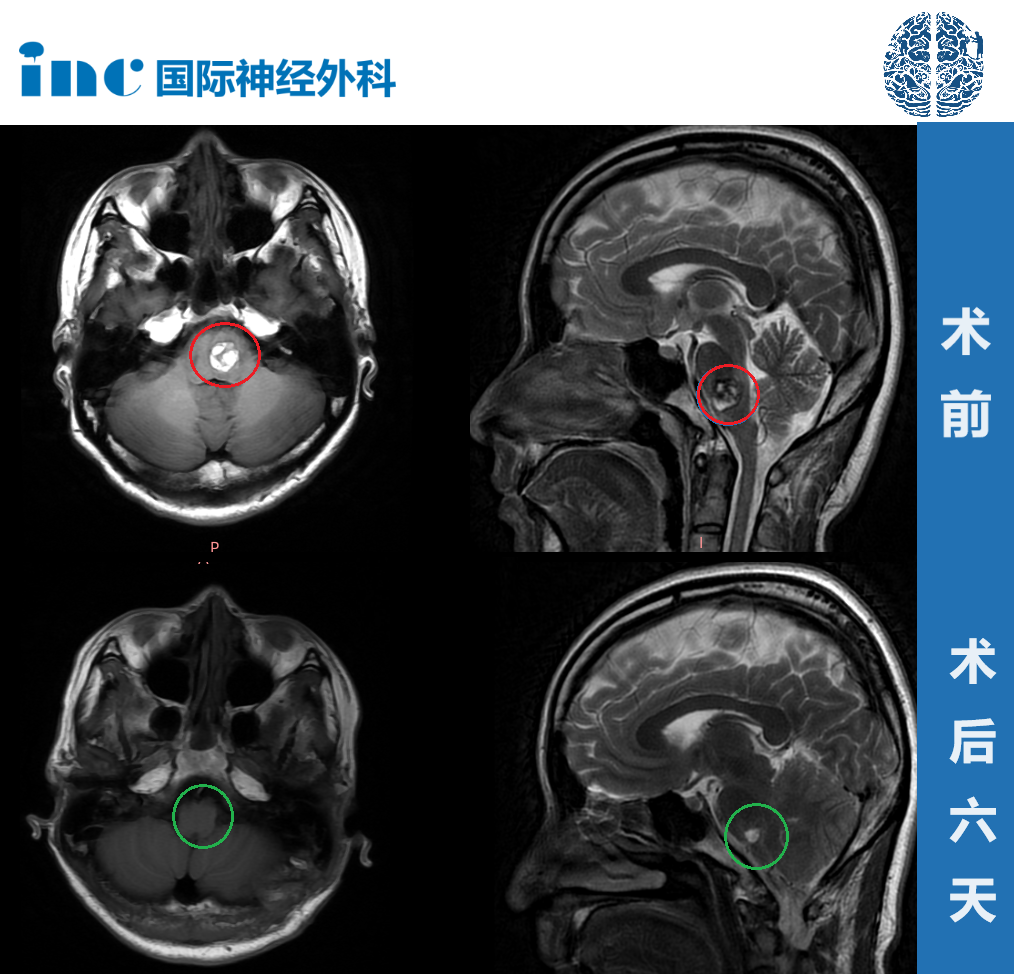 28岁高难度脑干延髓海绵状血管瘤真实案例——术后影像