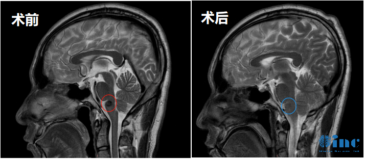 32岁男性-延髓海绵状血管瘤案例影像