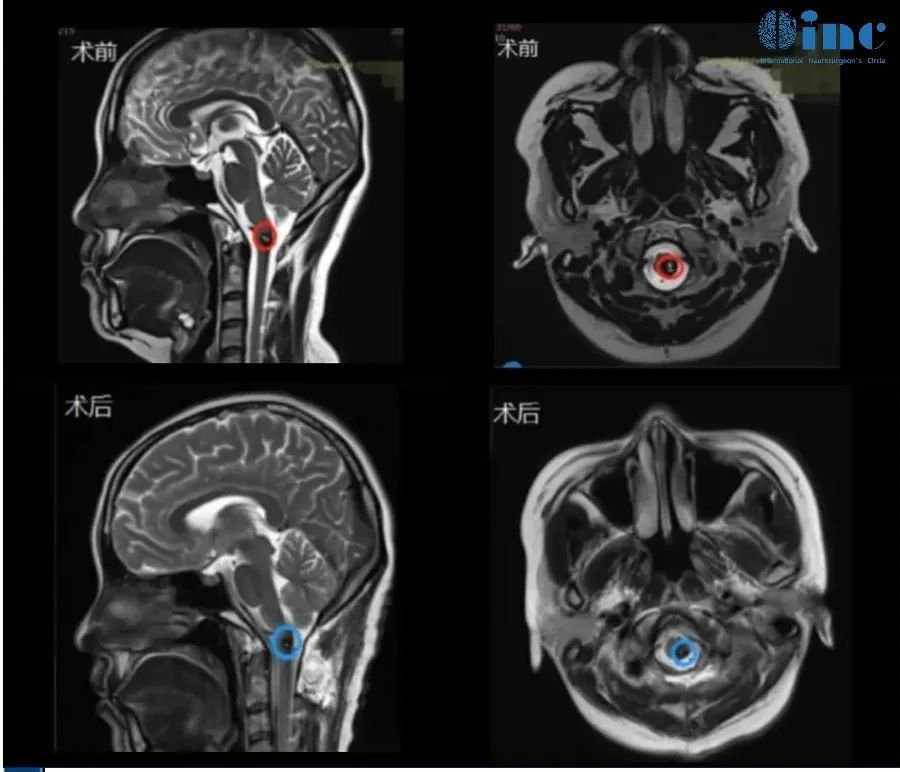 30岁女性-延髓-颈髓海绵状血管瘤影像图片