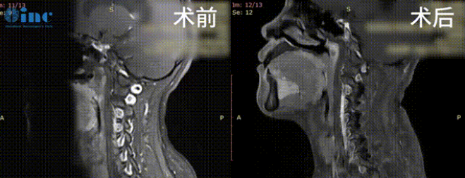 33岁女性-脑干颈髓室管膜瘤