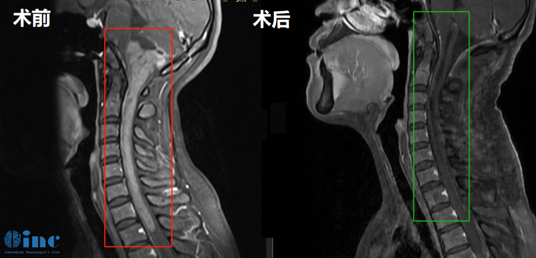 33岁女性-脑干颈髓室管膜瘤影像图片