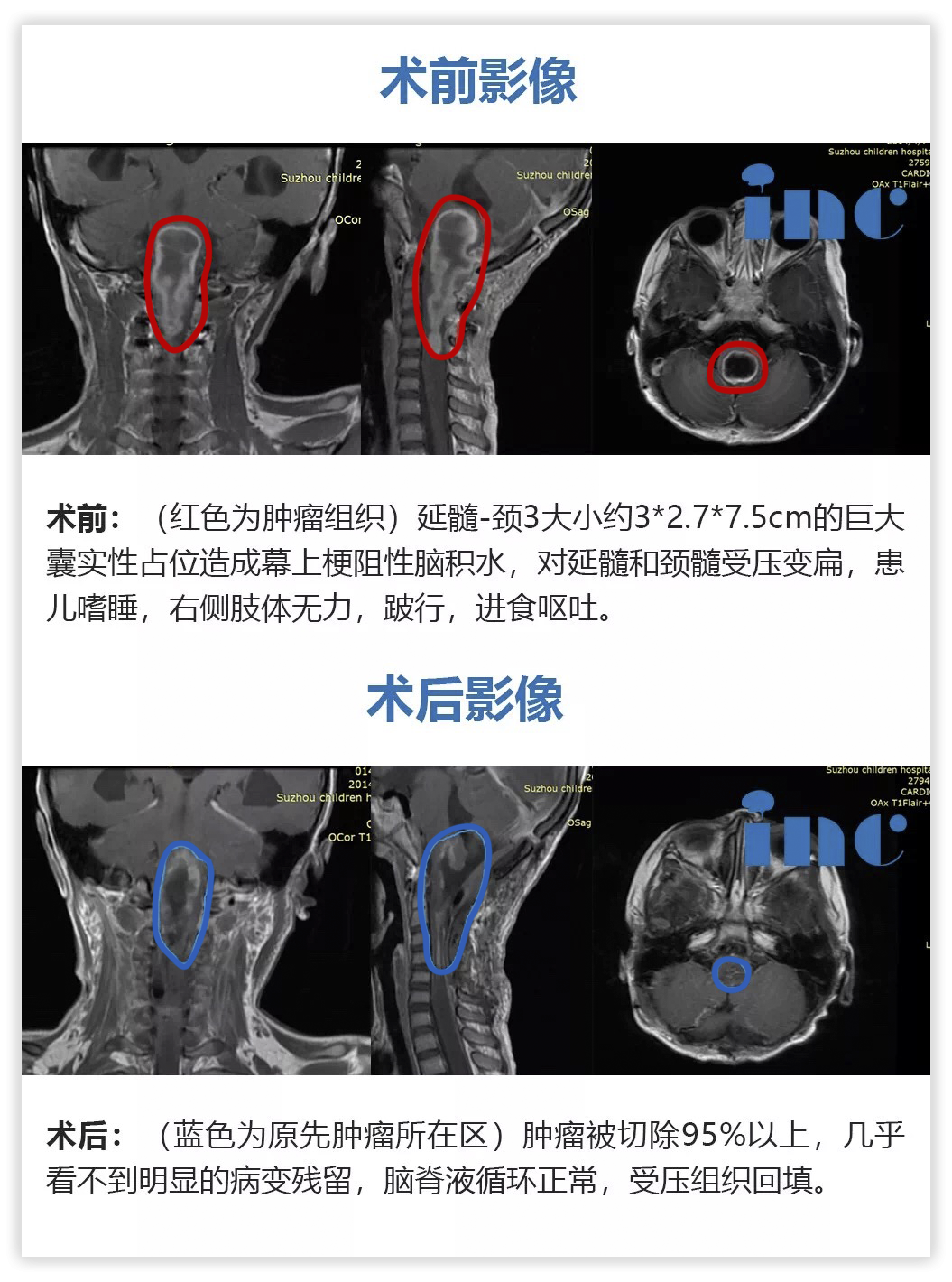 5岁女孩脊髓-脑干毛细胞星形细胞瘤图片