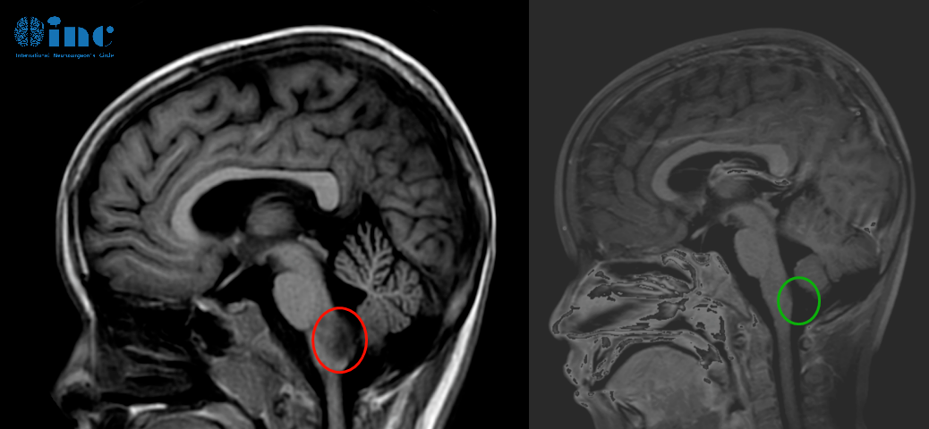 6岁男孩-延髓毛细胞星形细胞瘤