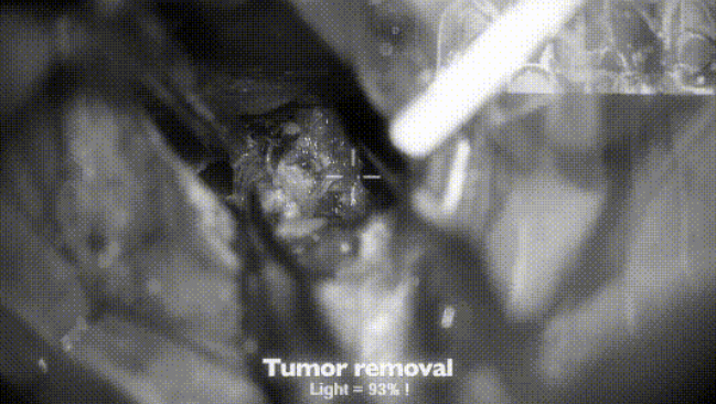 38岁女性蝶眶脑膜瘤肿瘤取出图片