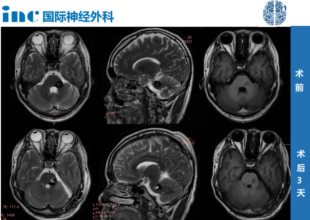 脑干海绵状血管瘤影像图片