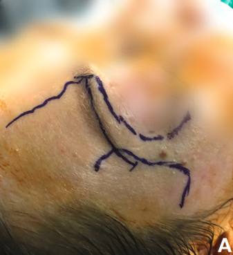 经眉弓锁孔手术切口图片