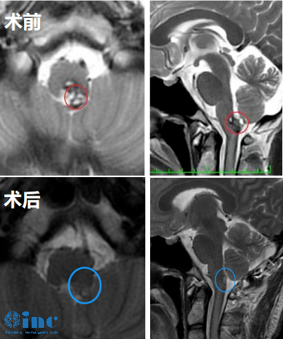 神经外科手术后为何要进ICU？为何他们能一天就顺利转出？