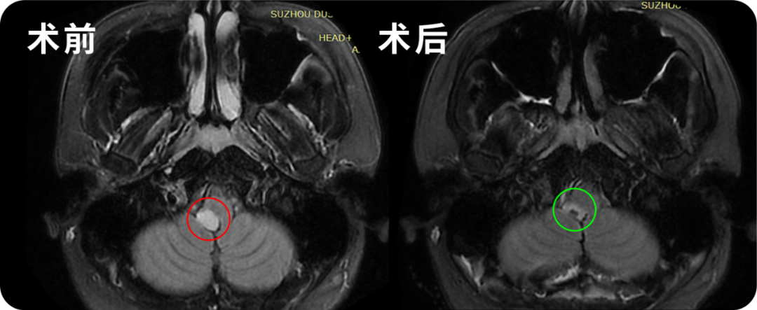 24岁男性-脑干延髓低级别胶质瘤