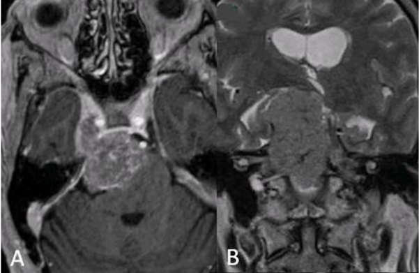 岩斜区脑膜瘤案例:脑肿瘤致70岁