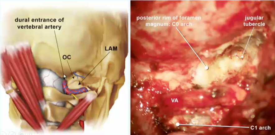 图13.5：左，经枕髁入路的术野集中在枕骨大孔背缘、椎动脉硬脑膜入口和寰枕关节。右，术中照片显示椎动脉（VA）V3水平段，围绕着寰椎侧方和枕骨大孔后外侧缘，形成所谓“C0”弓的外侧部分。