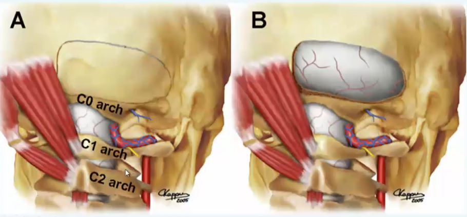 图13.6：图示为骨瓣开颅的轮廓设计。枕下颅骨磨除暴露小脑硬脑膜，而枕骨大孔（所谓的“C0”弓）的背外侧缘保持原位。在操作中，颅骨磨除不一定需要延伸到中线。