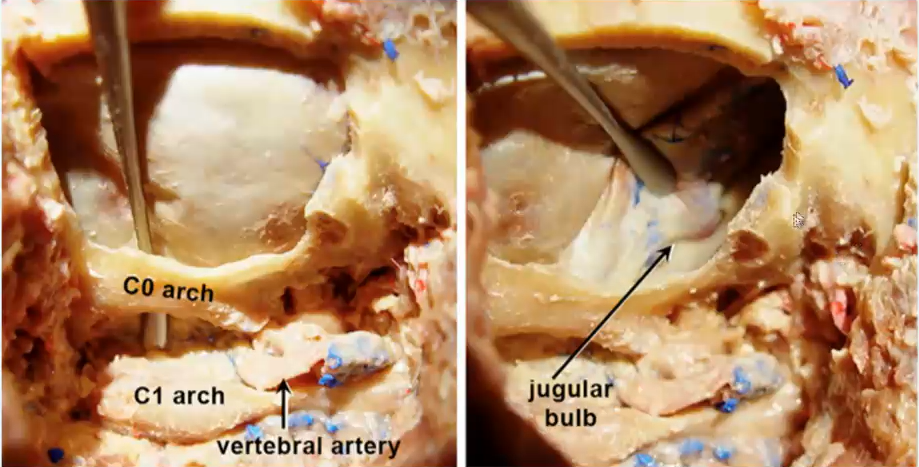 图13.7：尸解显示类似于上图所示的手术视野暴露，枕骨大孔的背缘（“C0”弓）留在原位，将硬脑膜与此缘分离（a）。其余枕骨外侧鳞片、枕骨大孔外侧缘、颈静脉突和寰枕关节内侧部分对应于随后切除的区域，即经髁入路的关键点（b）