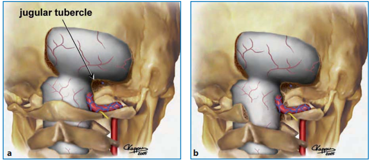图13.8：切除枕骨大孔后缘（所谓的“C0”半椎板切除术）和部分钻取枕髁和颈静脉结节后典型暴露的图示；这种暴露可以不进行（a）或包括（b）C1半椎板切除术