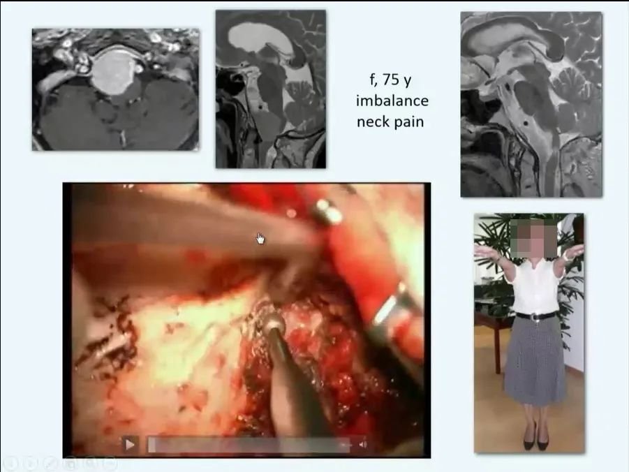 枕骨大孔区脑膜瘤成功真实案例图片2