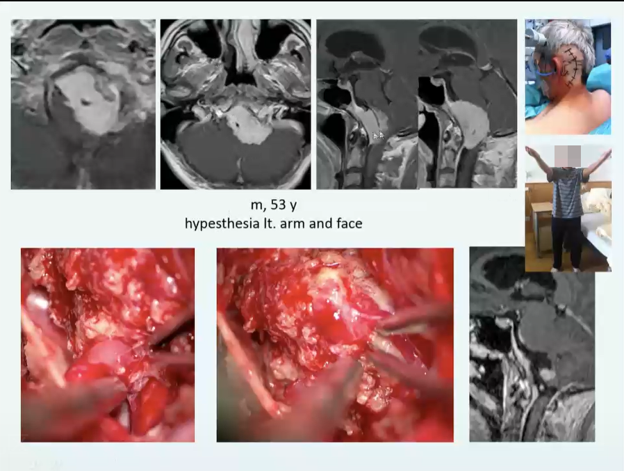 枕骨大孔区脑膜瘤成功真实案例图片6