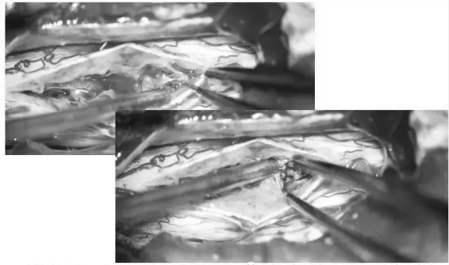巴特朗菲教授手术图片——用精细的双极或者剥离子沿含铁血黄素沉积带，分离海绵状血管瘤并电凝切断供血分支血管
